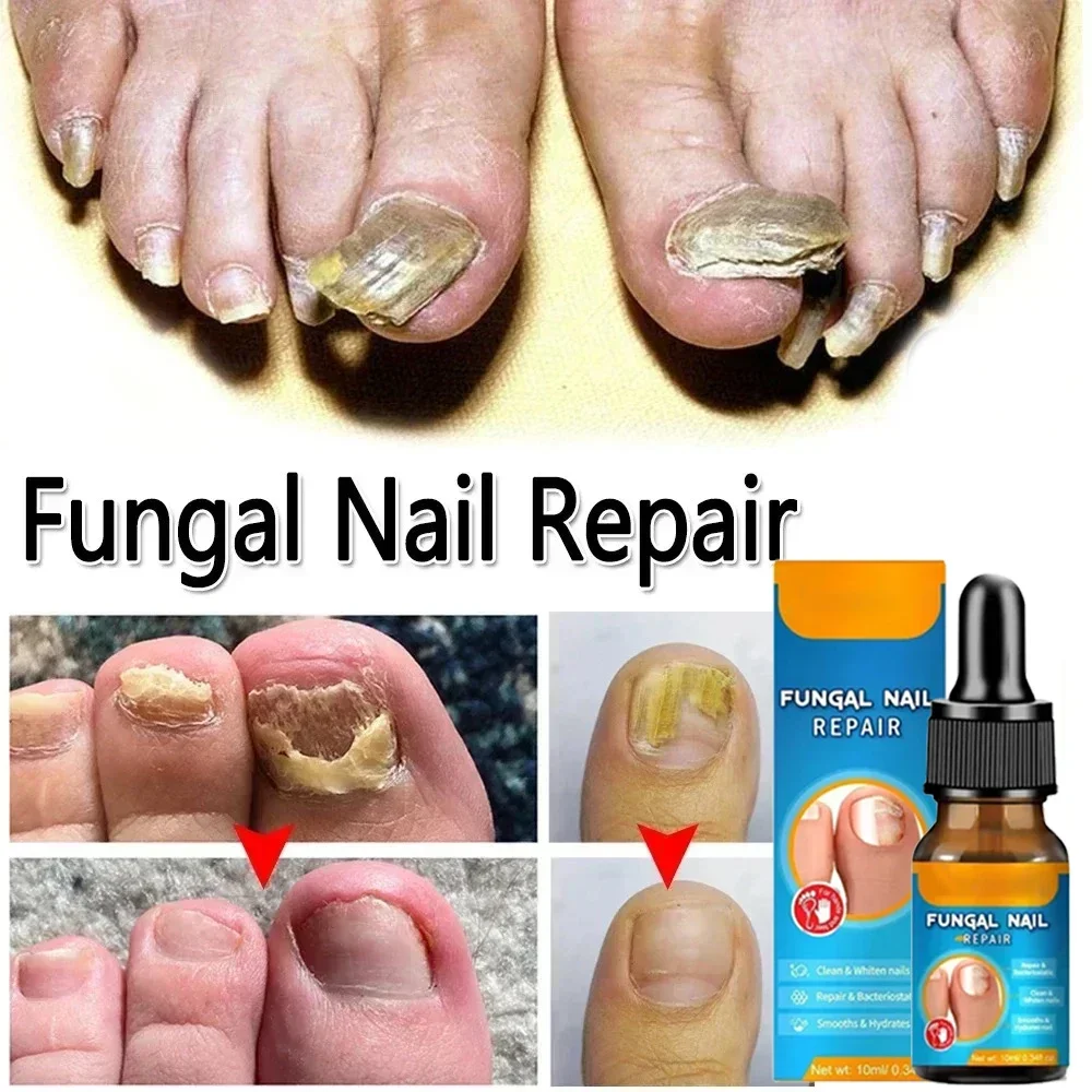 

NewFungal Nail Treatment Oil Foot Repair Essence Toe Nail Fungus Removal Gel Anti Infection Cream Fungal Nail Removal 10ML