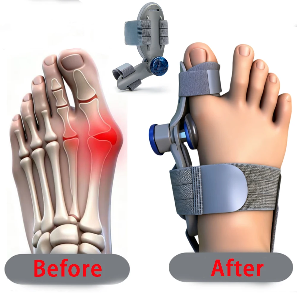 Unisex Hallux Valgus Braces Adjustable Bunion Fix for Big Toe Separation Pain Relief Orthopedic Bunion Splint with Straightener