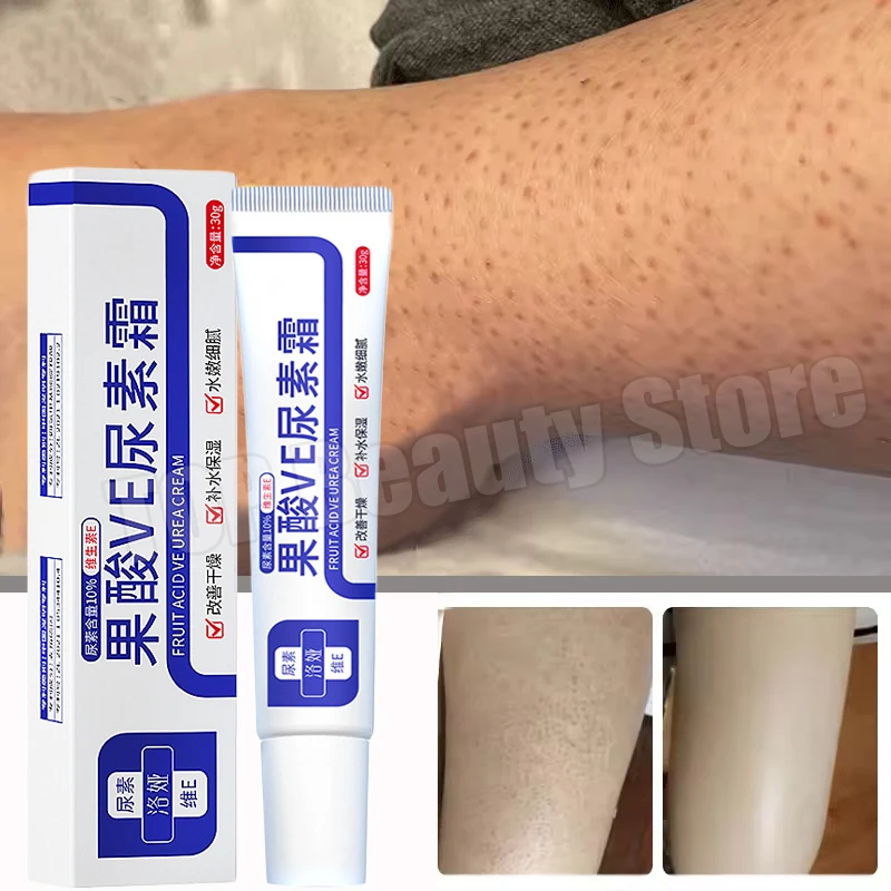 

Curing Keratosis Pilaris Repair Cream Chicken Follicle Skin Body Scrub Brighten Dark Spots Remove Smooth Moisturize Skin Care