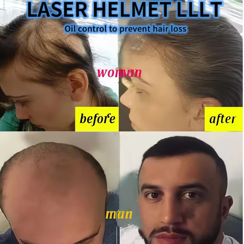 650nm Laser Hair Growth Cap Low Frequency LLLT for Safe Hair Regrowth and Restoration