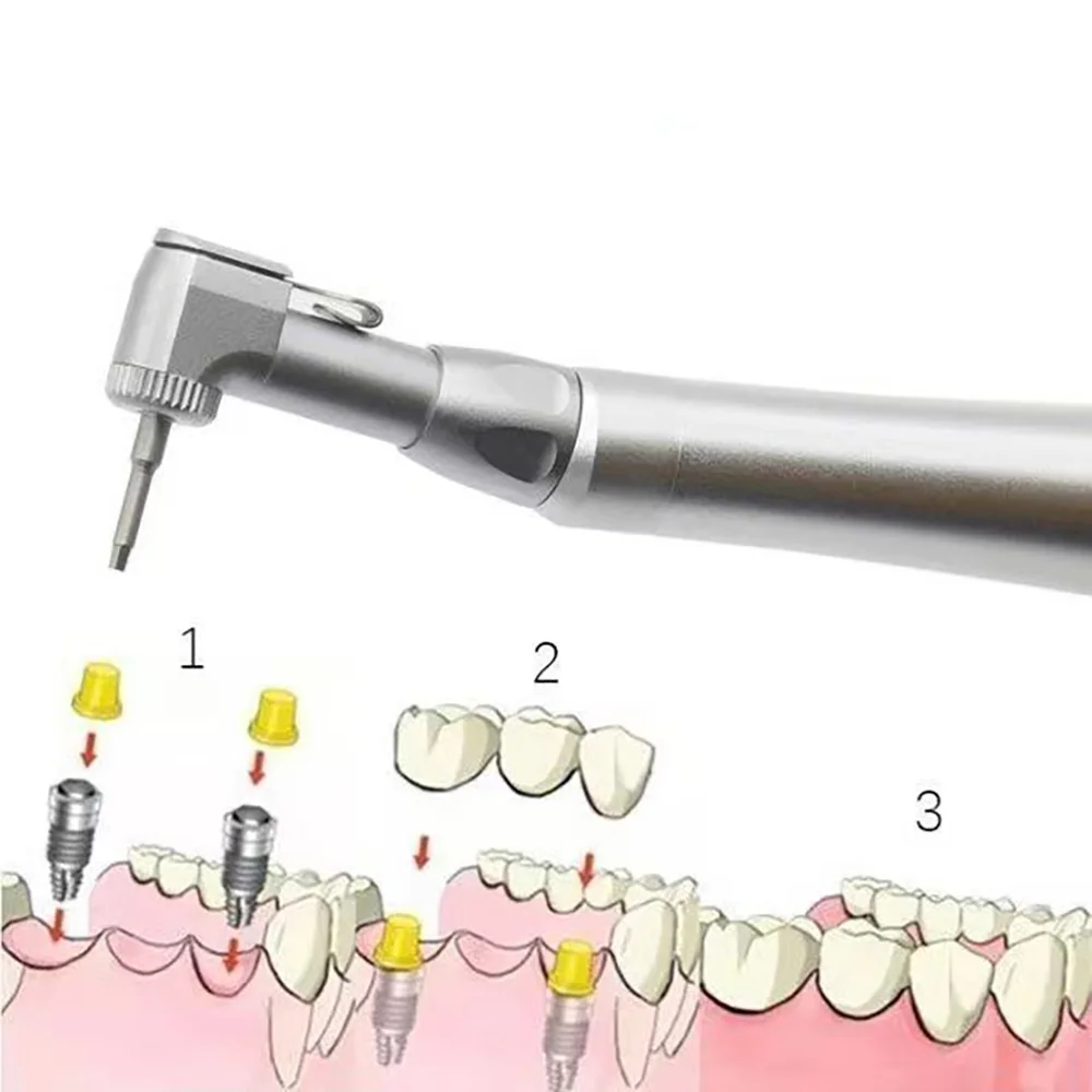 Dental uniwersalny Implant klucz dynamometryczny rękojeść z kontrolą sterowników Hex Anthogyr Fit Spanner trwałe narzędzia zestaw