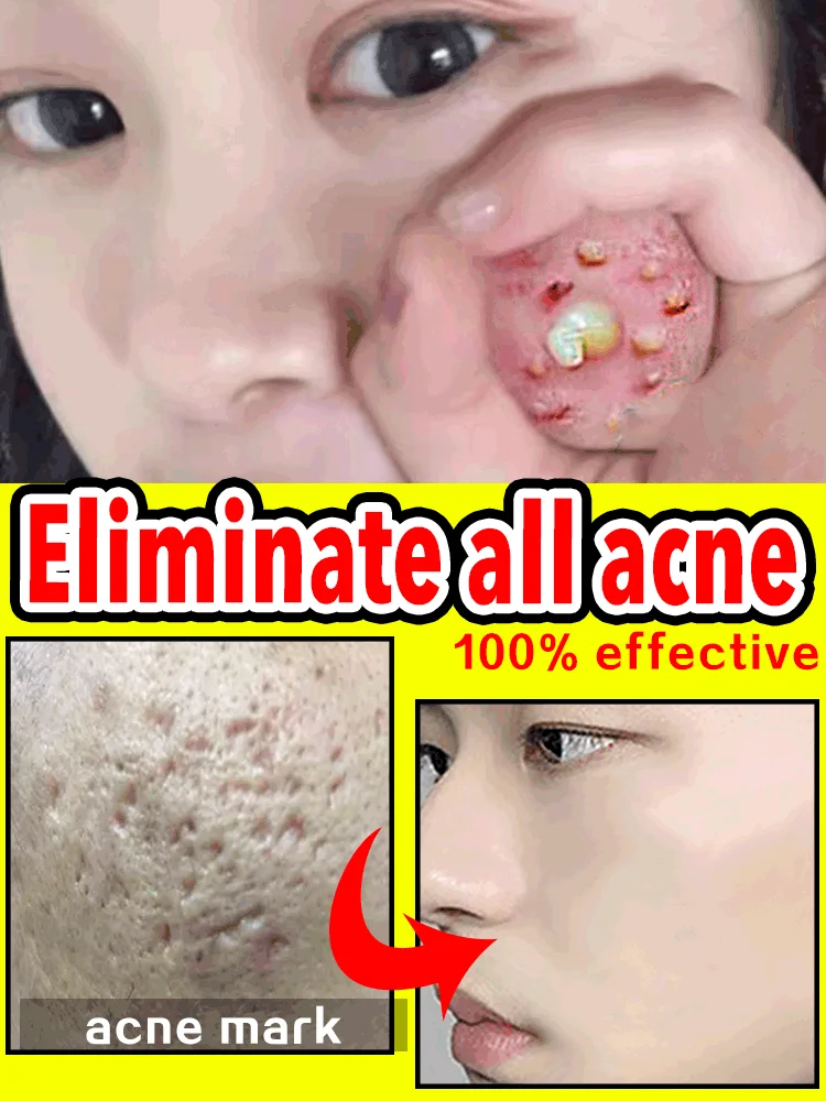 Acne Treatment Cream For Face Scar Serum Remover Remedy