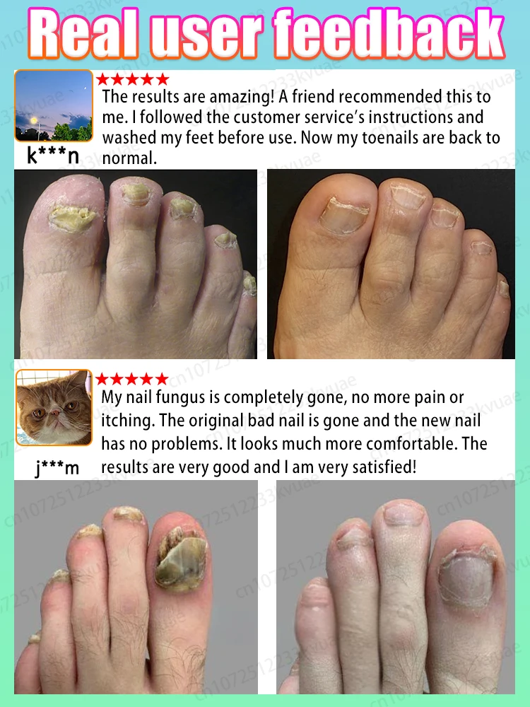 บอกลาโรคเล็บเล็บเล็บมือเล็บเท้า ผลิตภัณฑ์สำหรับทำเล็บ