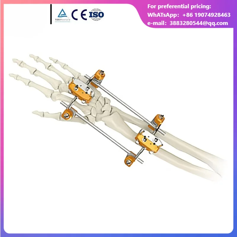 Hoffmann Type Orthopedic External Fixator, Trans Articular Ulna Radius Type For Radius Bone Fracture Fixation
