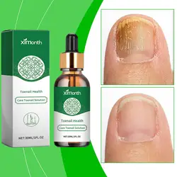 30ML Nail Fungal Treatment Essence Oil Foot Toe Nail Infection Fungus Gel Care Serum Onychomycosi Products Repair Removal A A9M3