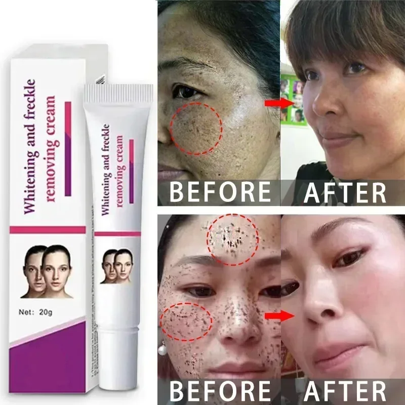 Freckles Removal Cream Remove Facial Spots Skin Dark Spot Remove Melasma Age Spots Sunspots Whitening And Freckle Removing Cream