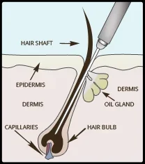 آلة التحليل الكهربائي غير الغازية المنزلية المتقدمة لإزالة الشعر الأبيض - مستلزمات التجميل عبر الإنترنت