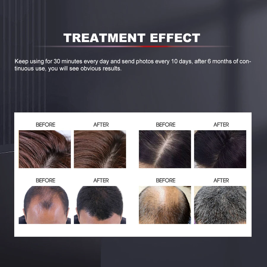 Berretto per la ricrescita dei capelli Dispositivo per la perdita dei capelli laser caldo Trattamento per la perdita Promuovere la crescita dei capelli