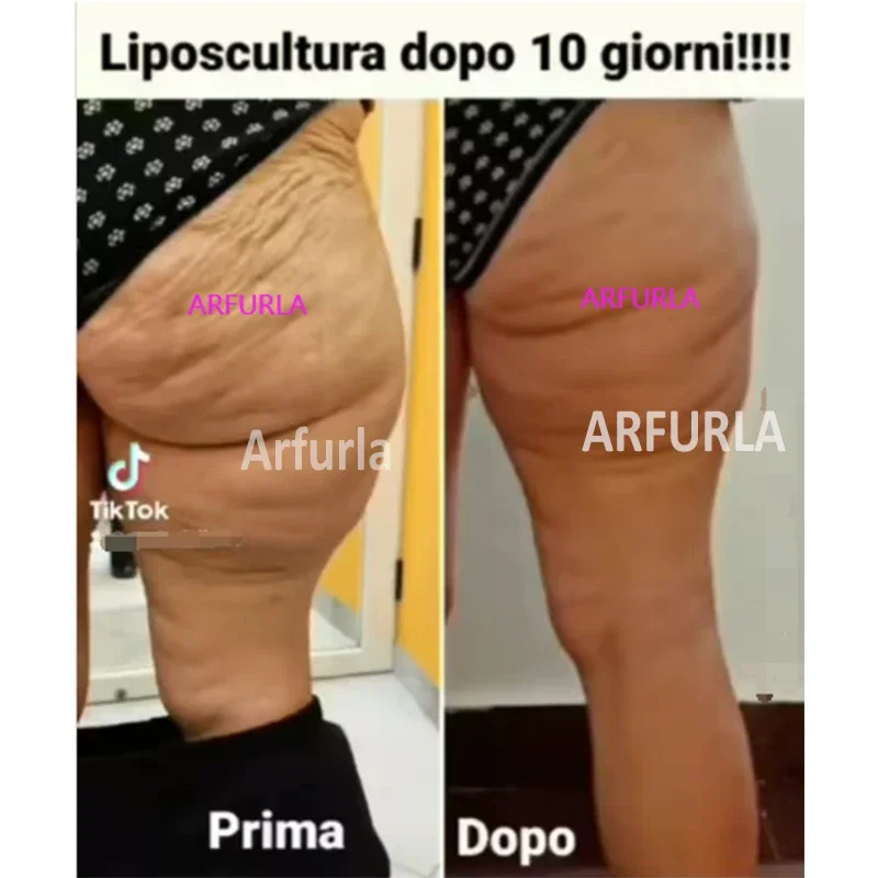 Fibra per lipolisi SMA 905 fibra di consumo medica 400um