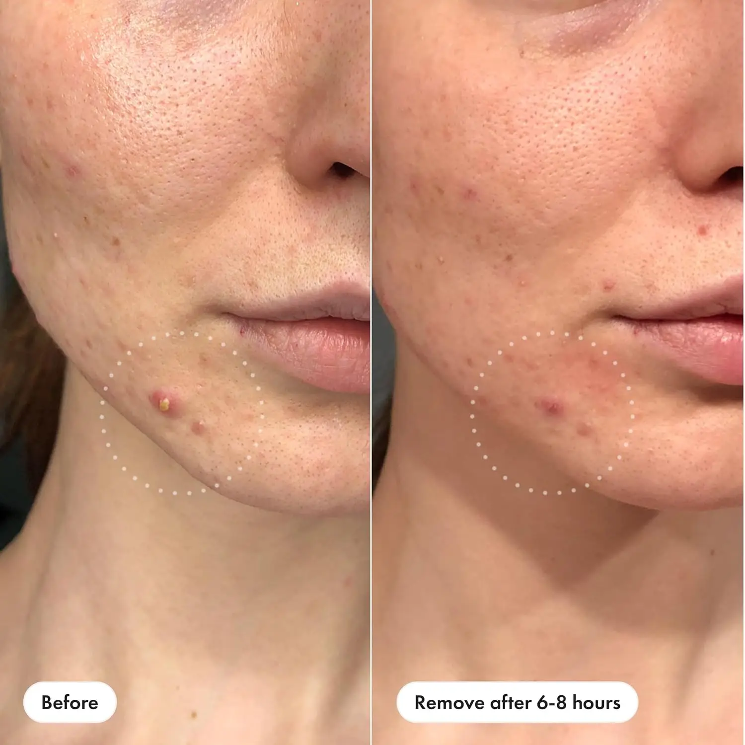180/360/720 patches/box of hydrogel acne patches can effectively cover acne patches, suitable for both men and women - view 6