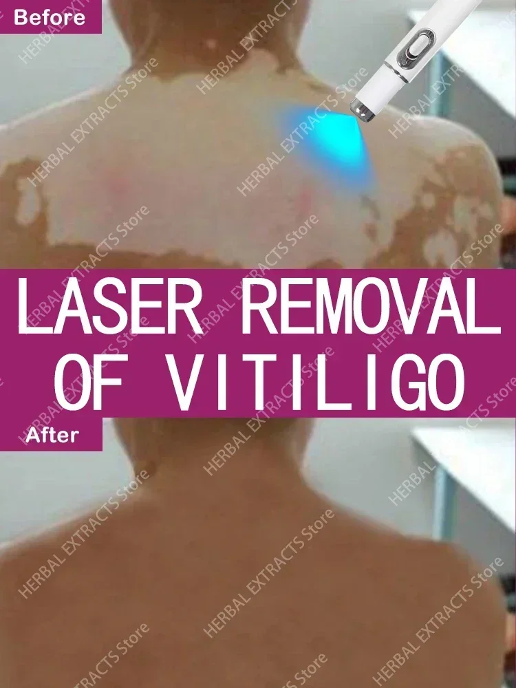 Combinando Laser e Cremes para Tratamento do Vitiligo