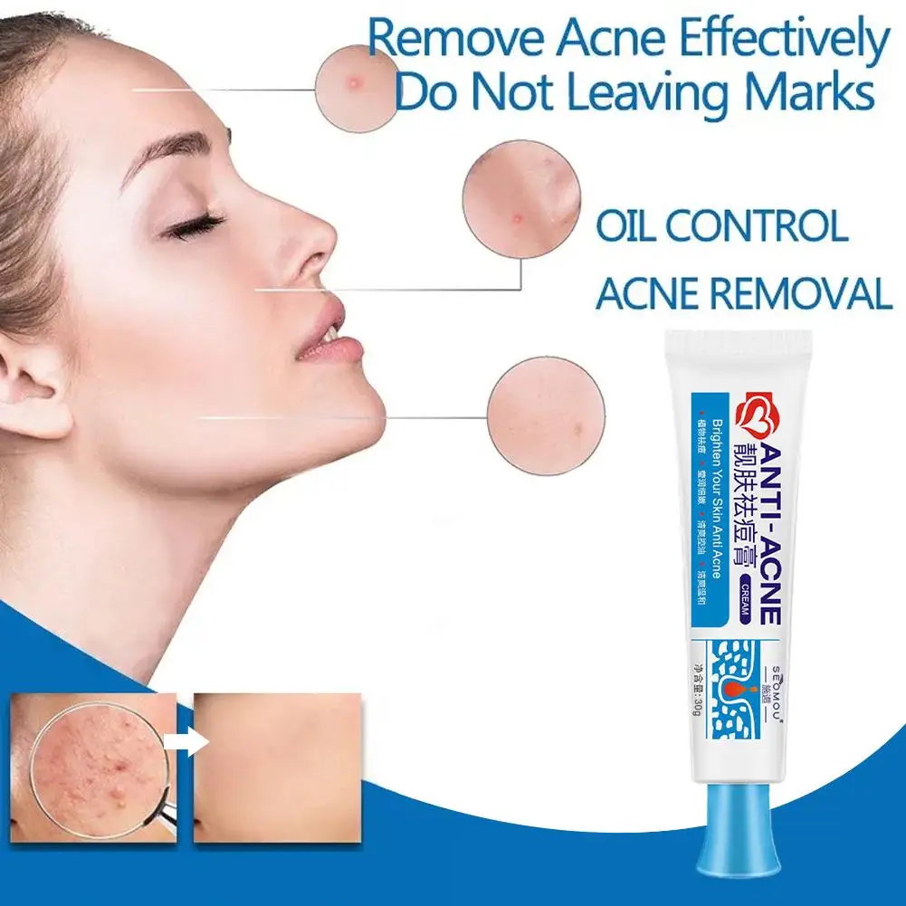 25G Acne Verwijderingscrème Anti-Acne Gel Effectieve Behandeling Puistje Spot Litteken Mee-Eterolie Controle Vochtinbrengende Crème Huidverzorging