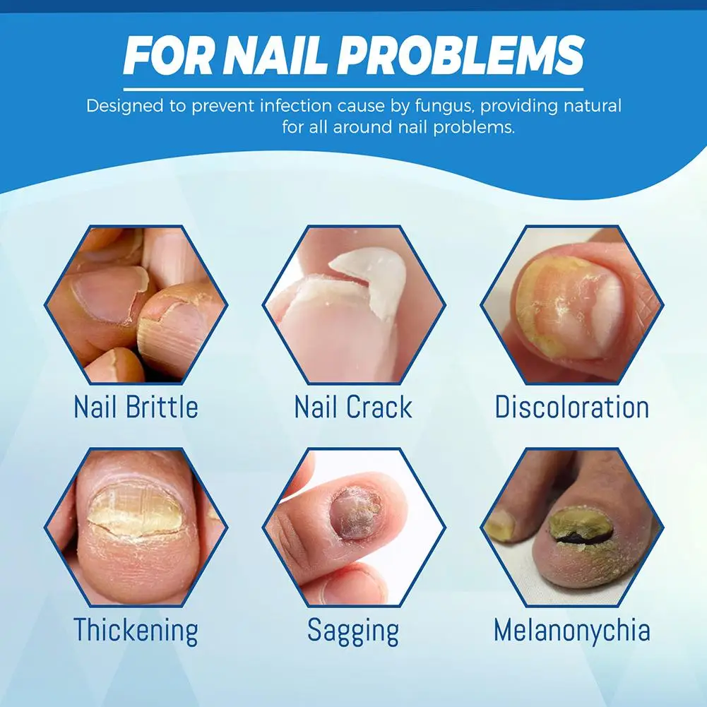 Máquina de cura a laser para fungos nas unhas, dispositivo per cuidados com os pés, tratamenti de unhas, anti-infezione, paroní