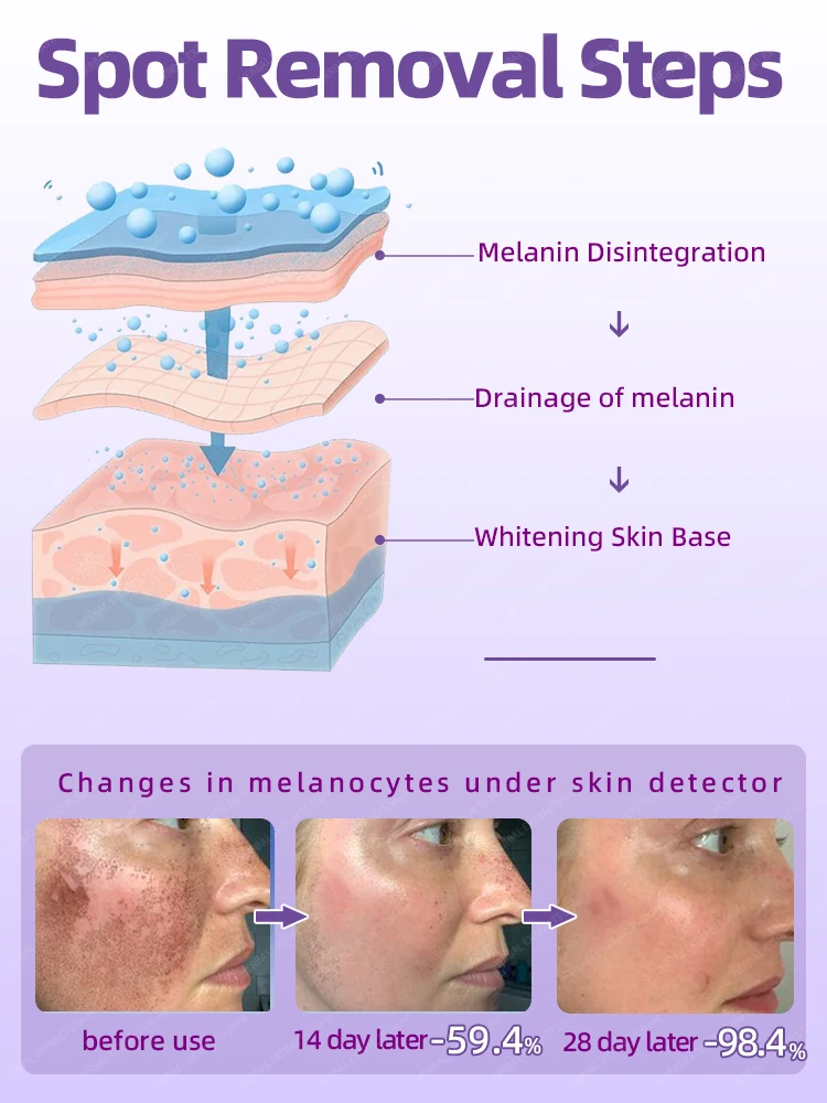 Freckles Dark Spot Melasma Age Spots