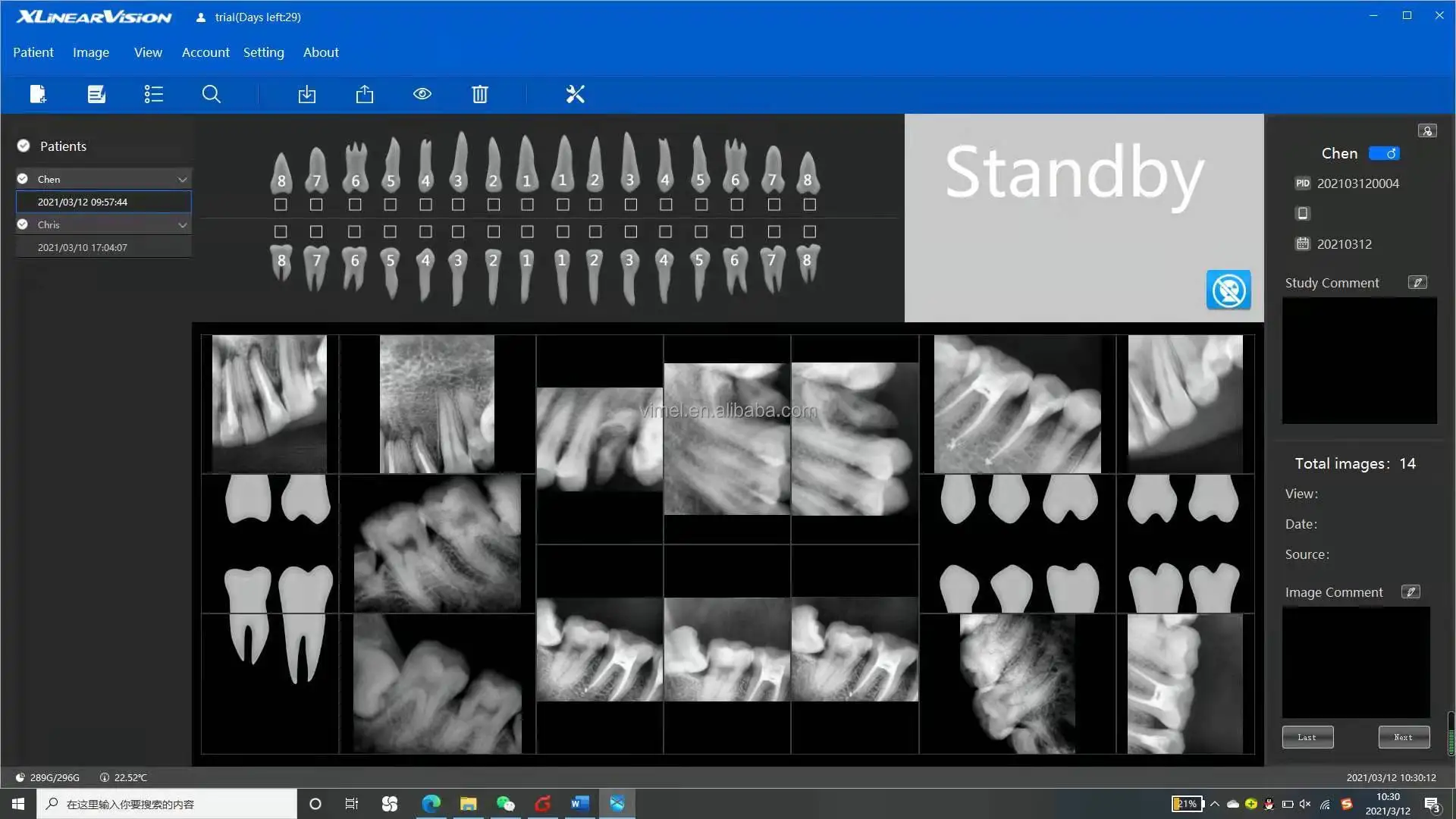 Bigger Size 2 Dental oral cavity treatment portable x ray sensor price RVG radiography intraoral xray sensor