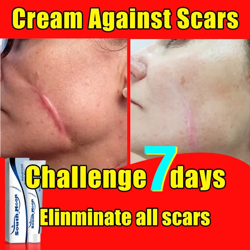 Scar Removal Cream Old Scar Cream Effective Repair New Scars Surgical Scars Stretch Marks Acne Pits Acne Marks Burn Scars