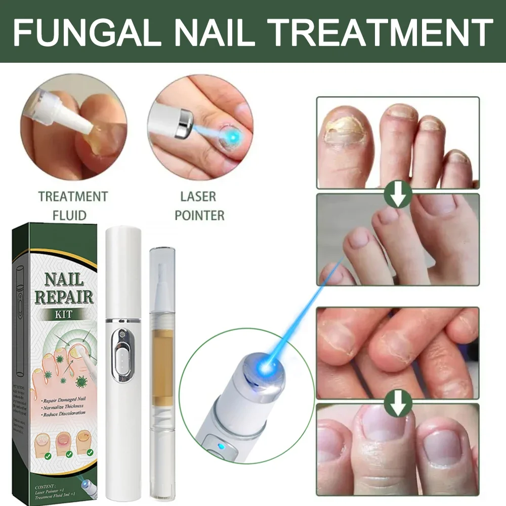 Toenail Laser Nail Fungus Treatment Laser Pen Anti Fungus Infection Fungal Remove Dispel Leuconychia Liquid Onychomycosis Grow