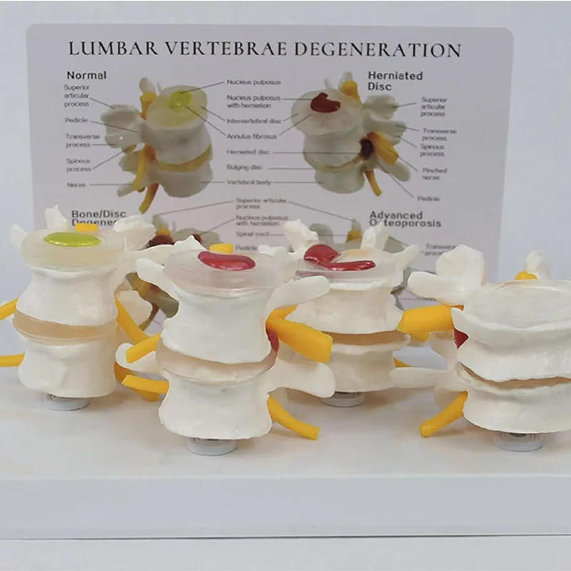 4-stage Pathological Human Lumbar Spine Anatomy Model Medical Science Teaching Resources