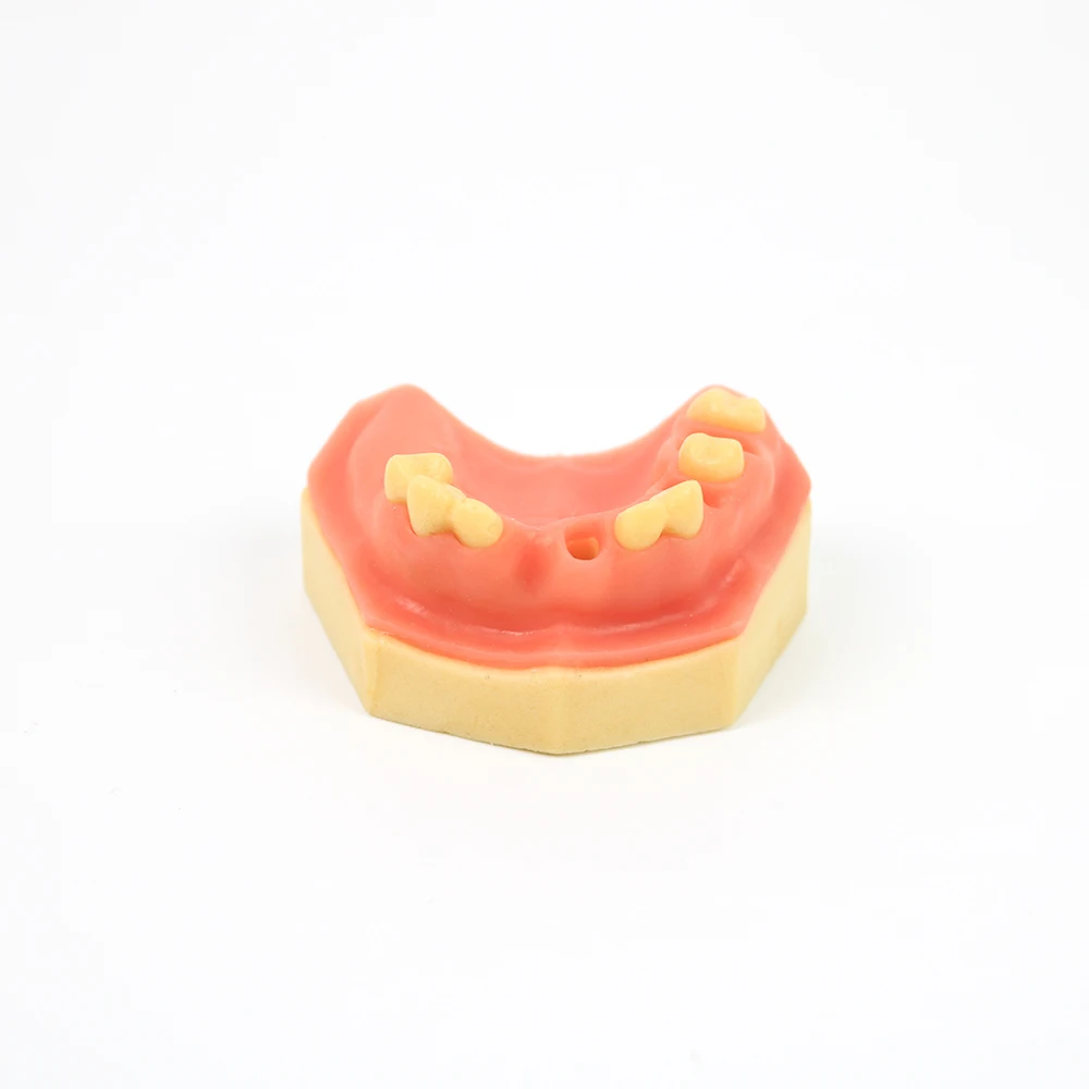 1pc New Dental Implant Practice Missing Tooth Model Upper Jaw Tooth Model Dental Research Teaching Model