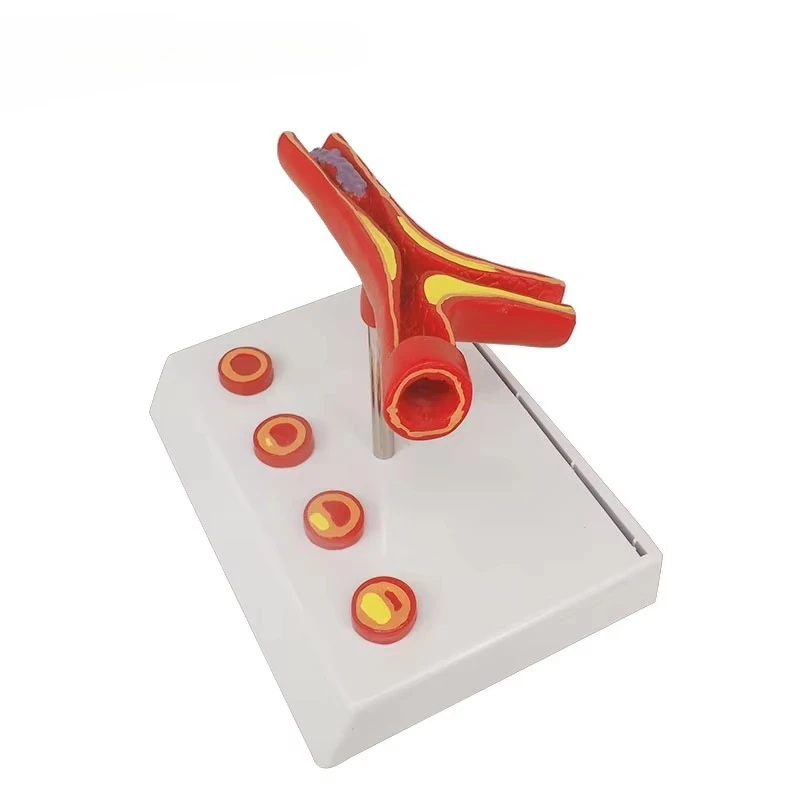 

Artery Section Anatomy Model with Blockage Artery Pathology Model Vein Model