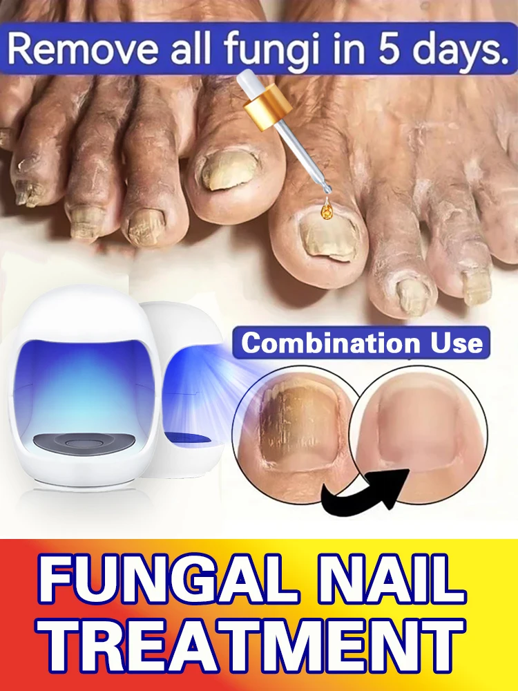 

Laser highly effective repair of feet nails