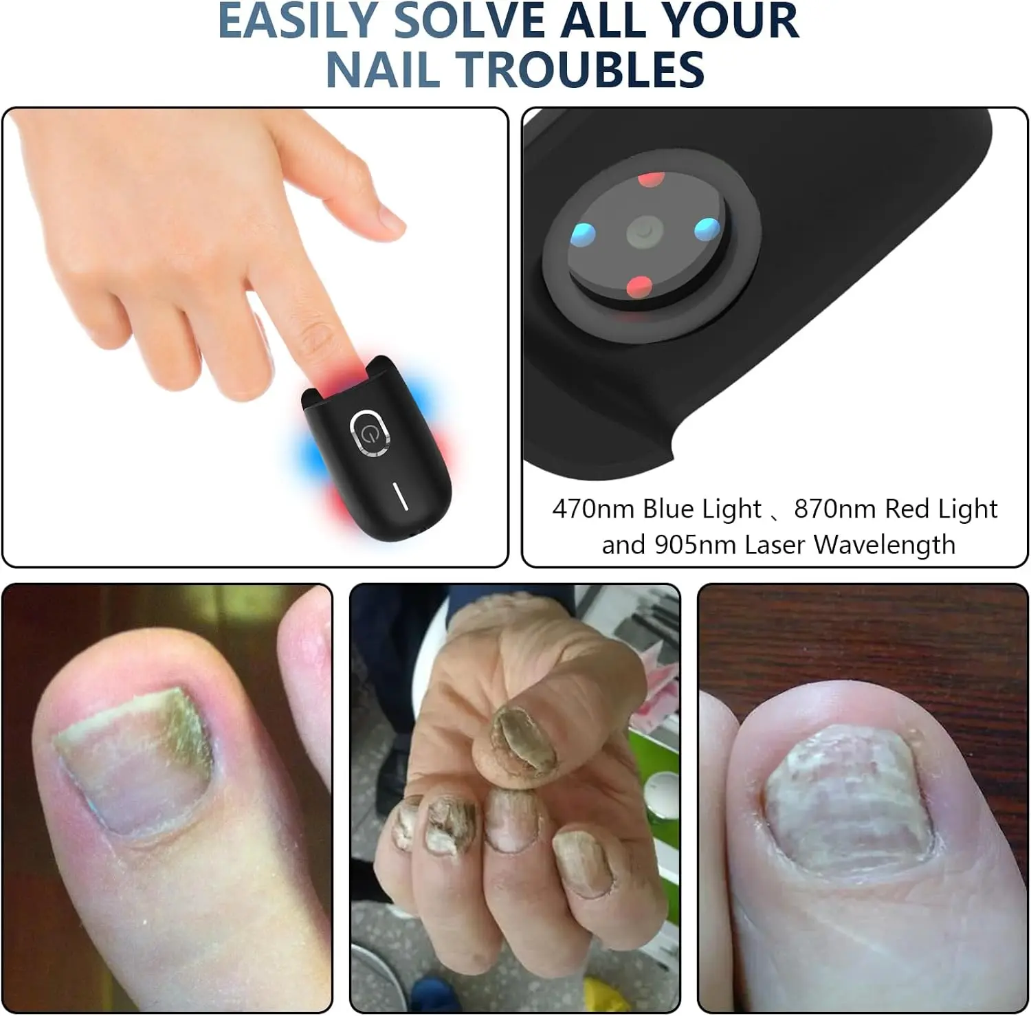 Nail Fungus Laser Device 470nm Blue Light&660nm Red Light&905nm Super Pulsed Invisible Light Smart Remove&Repair Fungal Nail