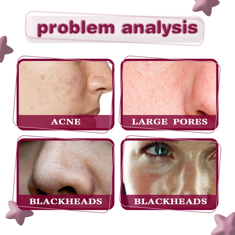 Salicylic Fruit Acid Face Serum  Shrink Pores Remove Blackheads Essence Whitening Moisturizing Smooth Skin Care Products