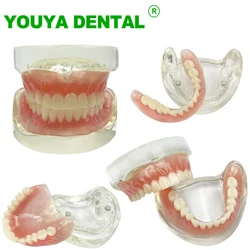 Dental Implant Model 2 Implant Overdenture Restoration Upper Lower Teeth Model Typodont Dentistry Products For Teaching Study