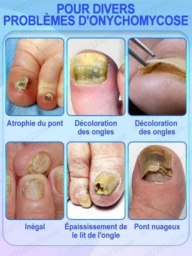 Sérum de traitement contre les mycoses des ongles