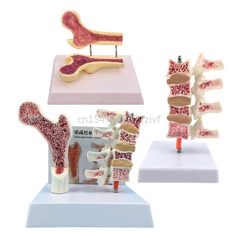 Human Femoral Osteoporosis Lesion Lumbar Anatomy Model Leg Bone Anatomy Spine Section Specimen