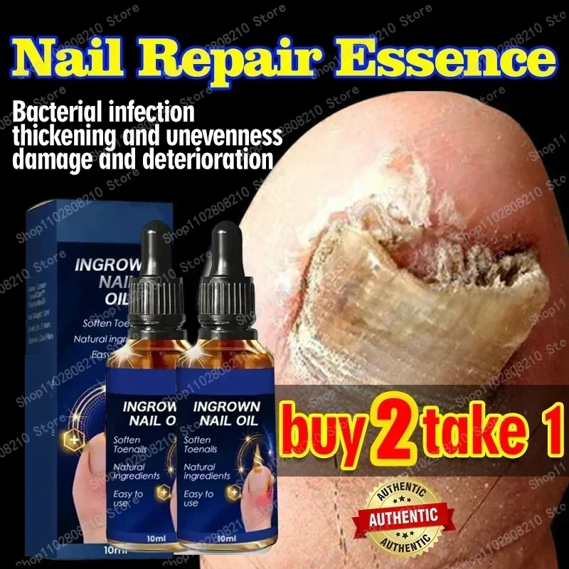 Nail Fungals Renewal Nail Repair Liquid for Discolored Thickened Crumbled Nails Nail Fungals for Discolored Broken Cracked S5F00