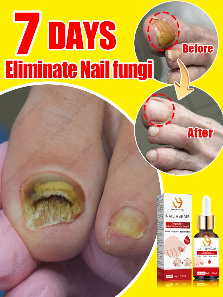 Oil Products For Solving Nail Problems