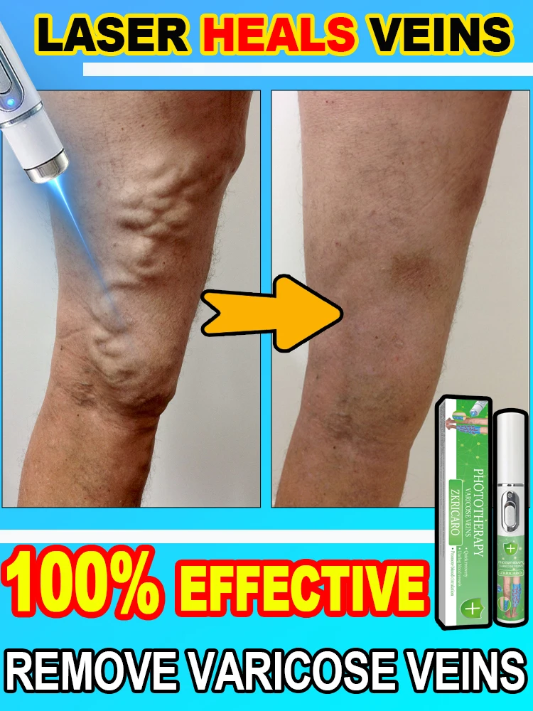 

Varicose Veins Products