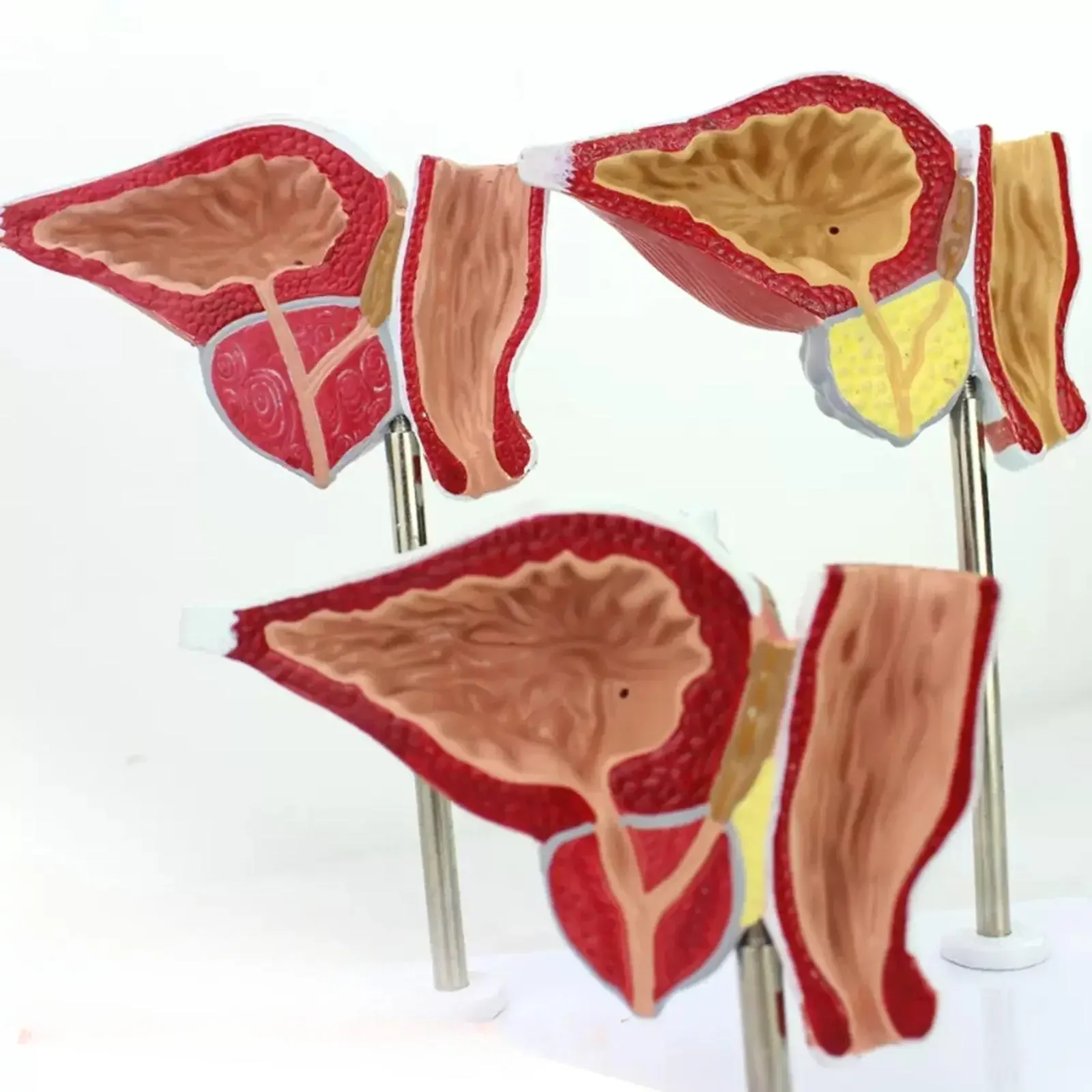 PVC Human Prostate Normal Hyperplasia Carcinoma Model Medical Teaching Models