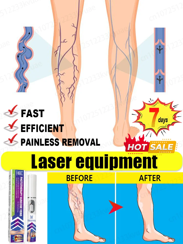 

Improve blood circulation and reduce varicose veins Laser pointer for varicose veins