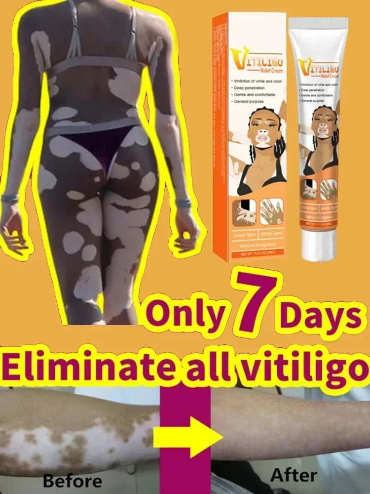 

Remove White Spot Eliminate Vitiligo skin Care Products 1006