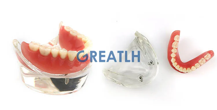 Clinic Decoration Dental Overdenture Interior Mandibular Lower with 2 Implant Restoration Teeth Study Teach Model