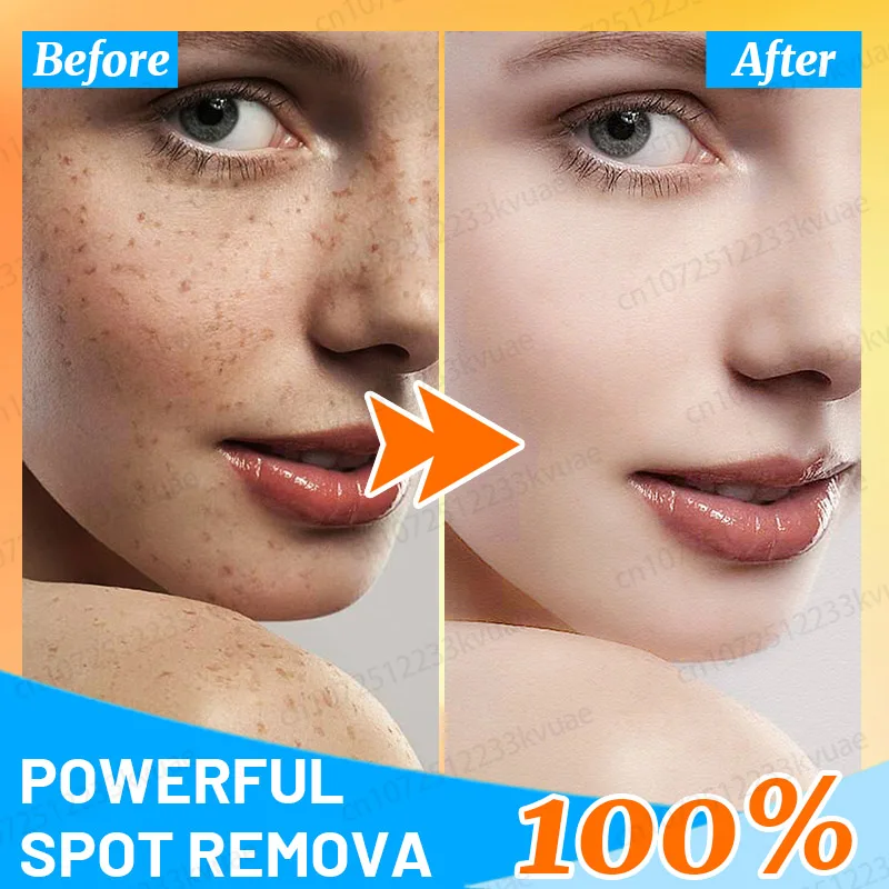 

Freckles Removal Facial Essence Remove Facial Spots Skin Dark Spot Remove Melasma Age Spots Sunspots Whitening Freckle Removing