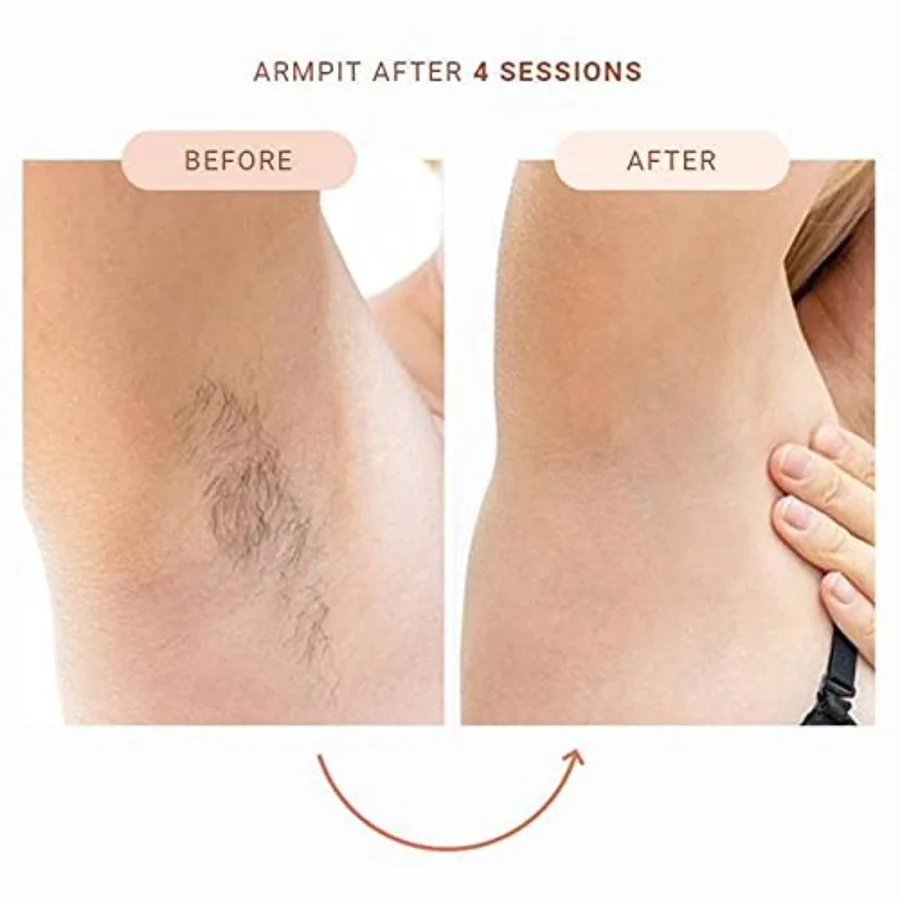 نظام إزالة الشعر بالليزر IPL للاستخدام المنزلي، جهاز تقليل الشعر الدائم للنساء والرجال، إزالة فعالة وغير مؤلمة #6