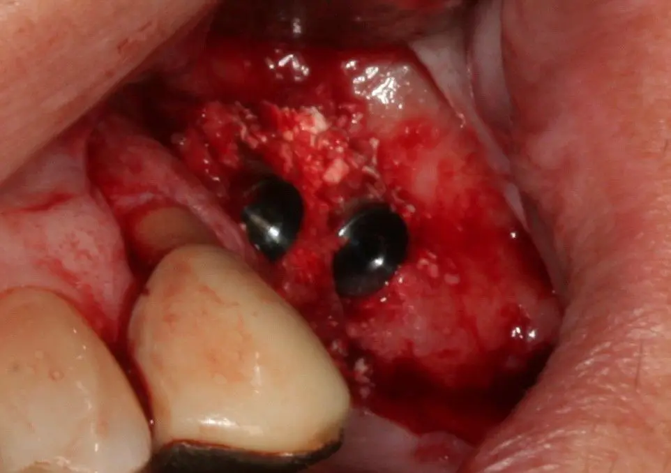 Resorba Parasorb Cone-stożek kolagenu dentystycznego