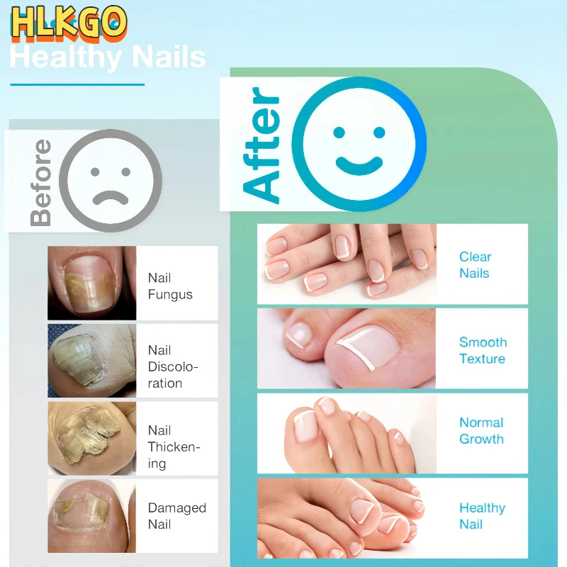 

Nail Fungus Laser Treatment Device for Toenails and Fingernails, Anti Fungus Infection Care for Onychomycosis & Paronychia