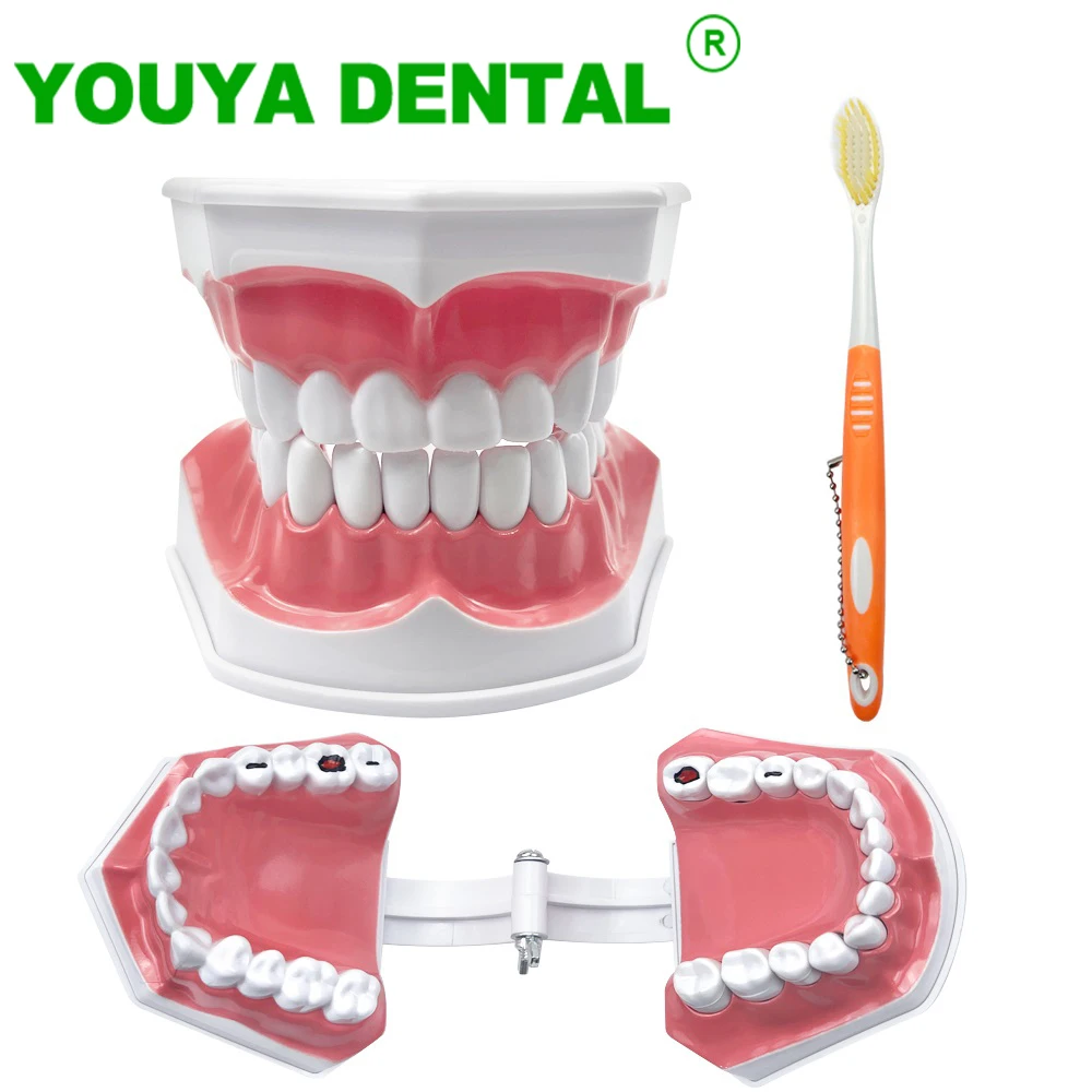 Dental Demonstration Model With Caries Standard Brushing Teeth Education Teaching Study Model With Toothbrush Dentistry Tools