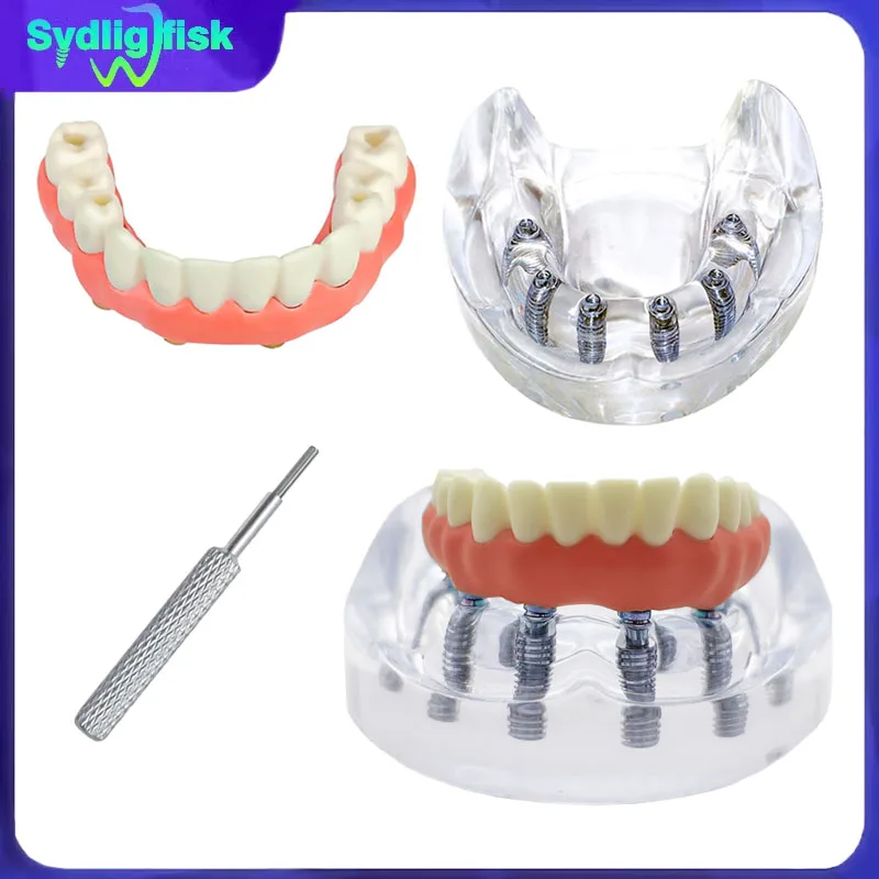 1Pcs Dental Implant Model 6 Implant Lower Tooth Implant Model Overdenture Removable Teeth Model Dentist Teaching Studying Model