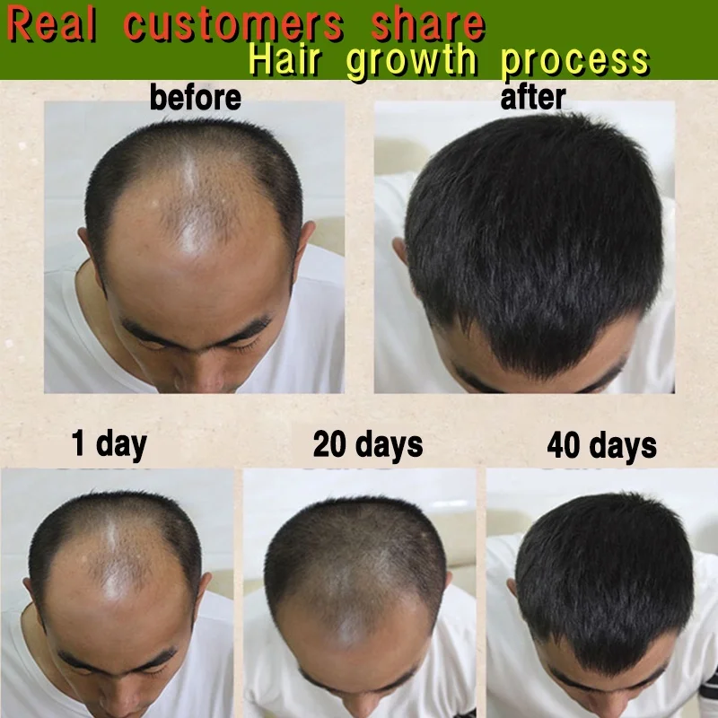 7DAYS Hair Growth Serum Spray  Anti Hair Loss 30ml Hair Growth Promotes Thicker Stronger Hair Hair Regrowth for Men Women