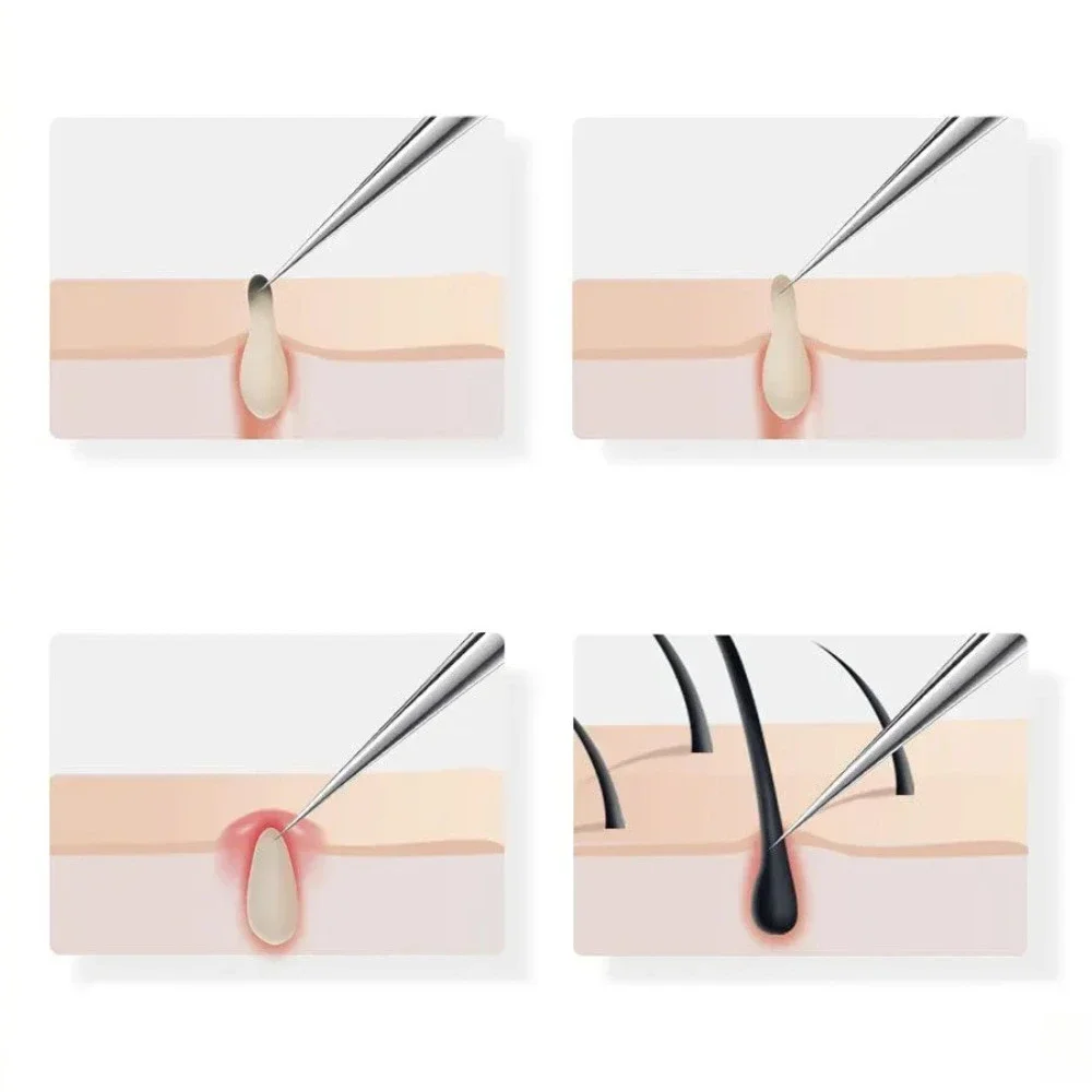 Pinzette di precisione per punti neri in acciaio inossidabile - Strumento per la rimozione dell'acne per la cura della pelle del viso Kit di bellezza professionale per estrattore di comedoni