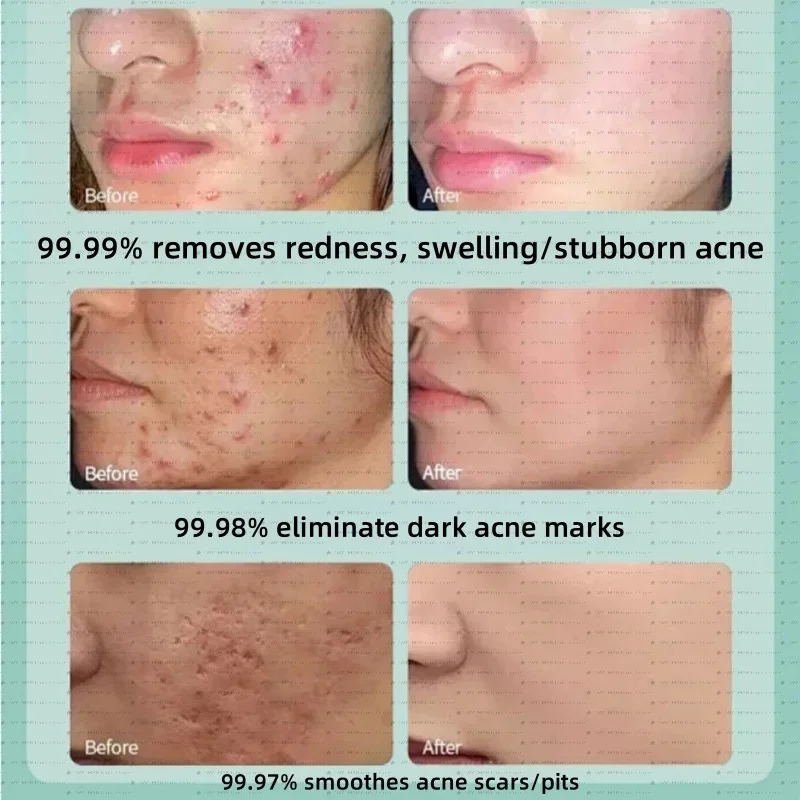 

Tea Tree Herbal Acne Cream Shrink Pores Blackheads Scars Acne Marks Blemishes Oil Control Whitening Korean Skin Care Cosmetics