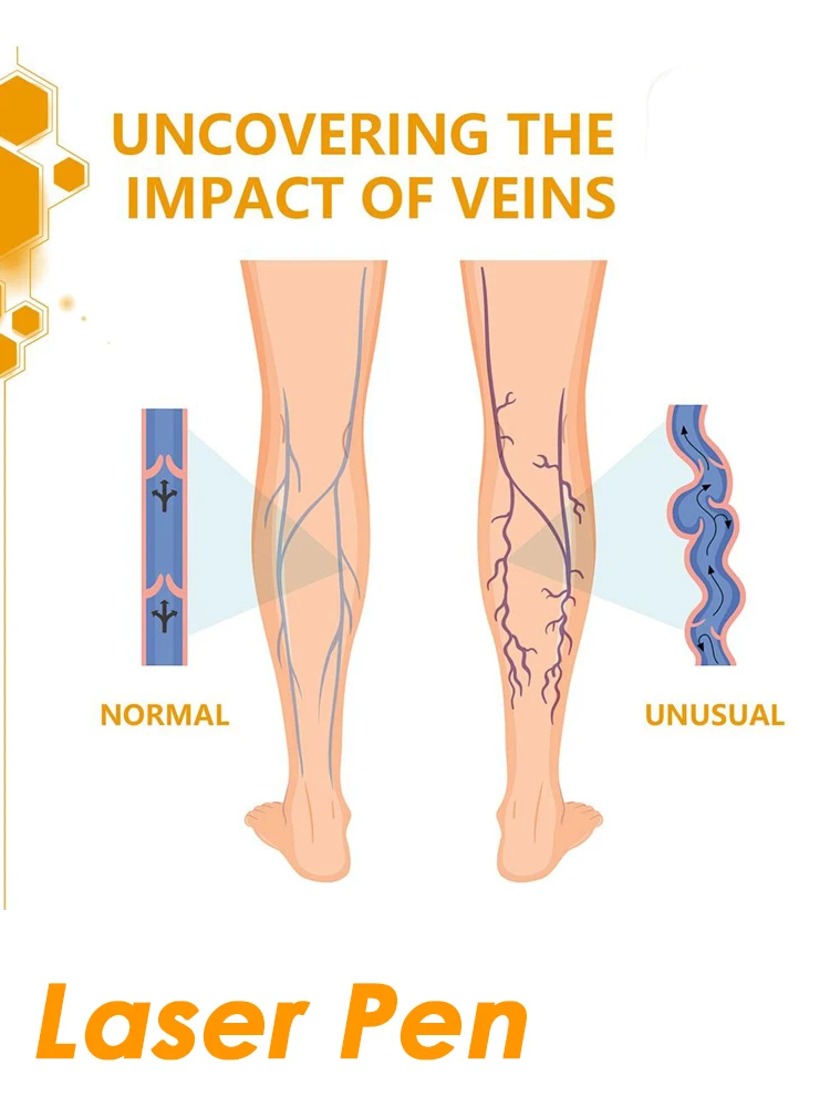 

Лазерная терапия вен, ручка для варикозного расширения вен, китайская травяная эссенция, крем для вен, 30 г, снимает пауковые вены, уход за ногами