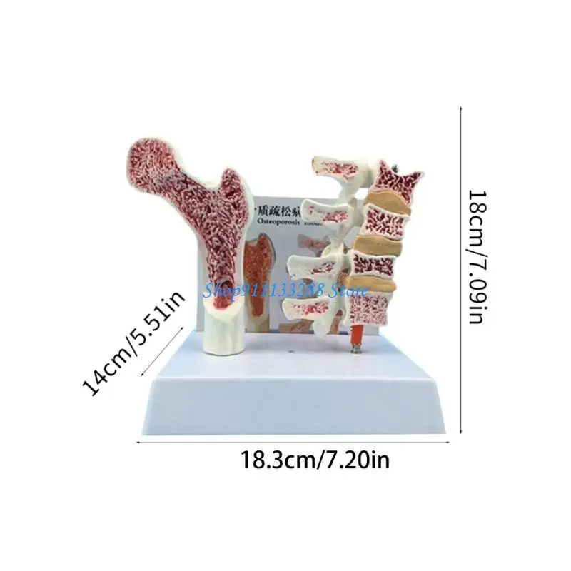 

G88D Human Anatomical Osteoporosis Model for Classrooms Clinics Patient Education Teaching Tool School Supplies