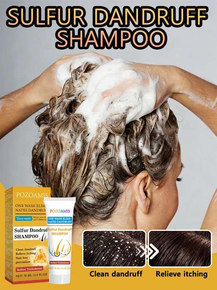 Sulfur Shampoo: Effectively Treats Stubborn Dandruff and Deeply Cleanses the Scalp