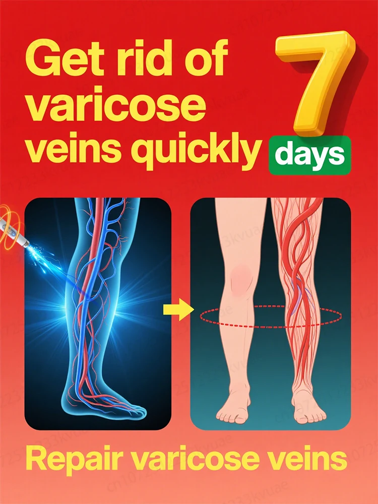 

Generation-8 Laser Says Goodbye To Spider Legs Varicose In 3 Days